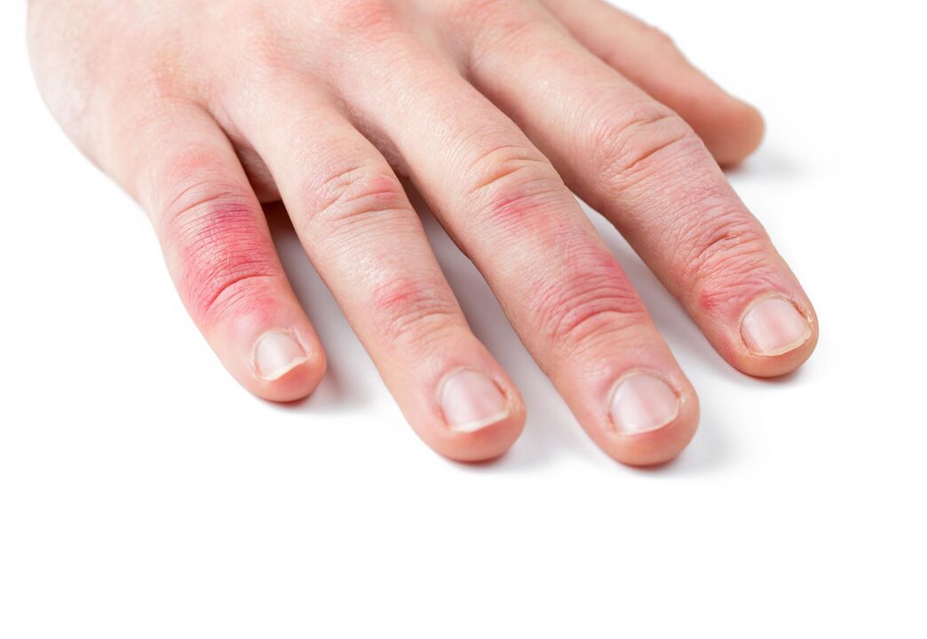 psoriasis in the hands of a child
