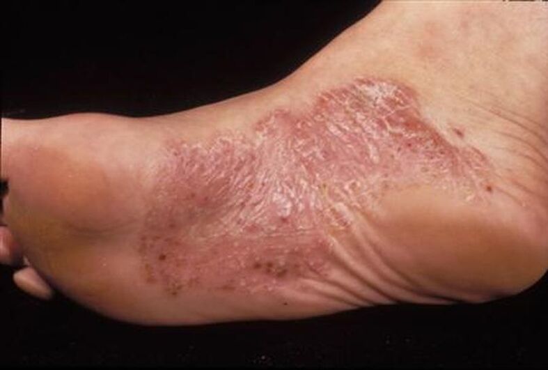 signs of psoriasis on the feet