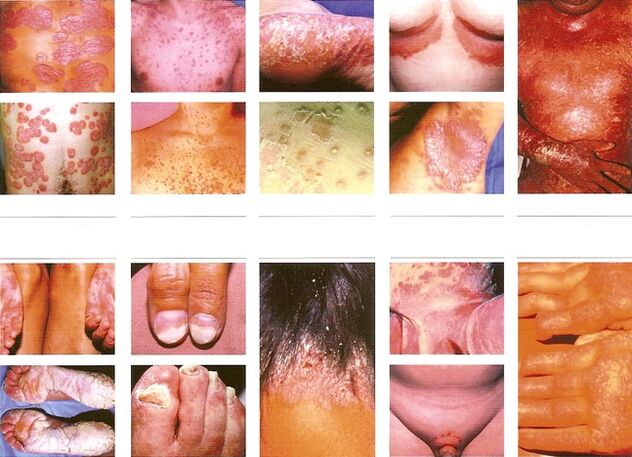 types of psoriasis in the body
