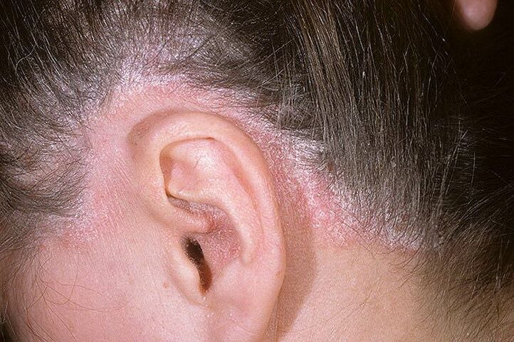 Psoriasis eruption, especially behind the ears