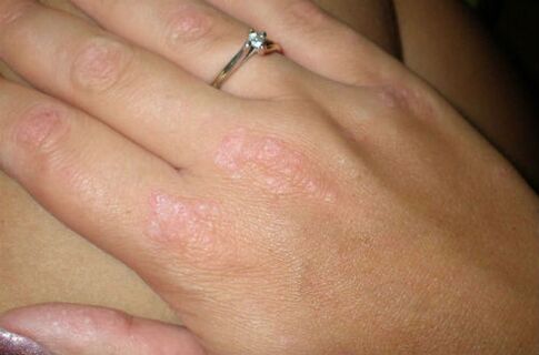 psoriasis in the hands