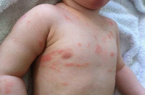 signs of psoriasis in a child