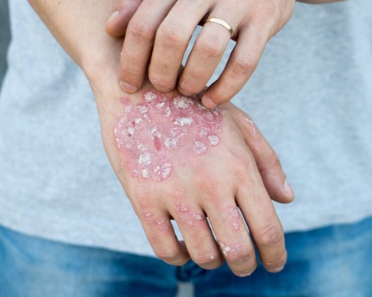 Psoriasis in his hand