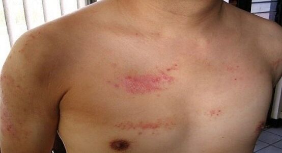 Psoriasis in the chest region