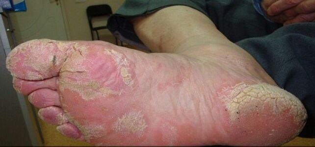 Psoriasis in the legs