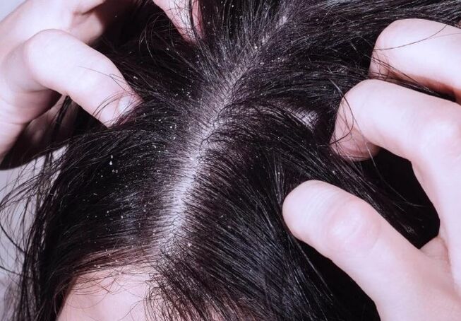 Psoriasis in the head