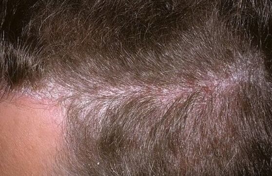 Psoriasis in the head