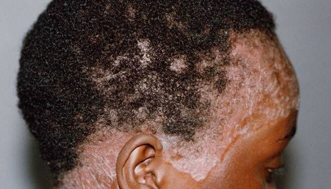 Psoriasis in the head