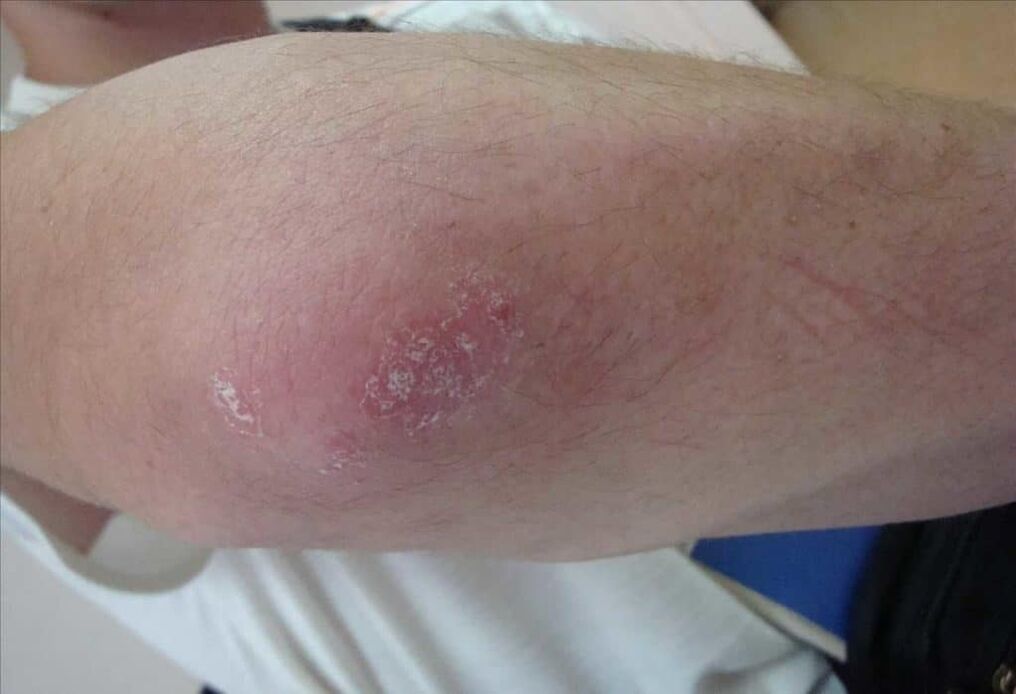 What does psoriasis look like