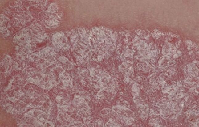 Healing of the papules