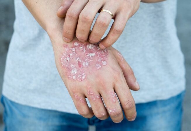 Meznichered psoriasis
