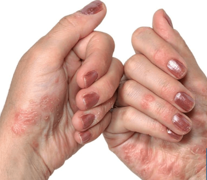 Psoriasis in his hand