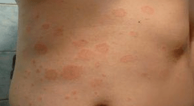 Failed psoriasis