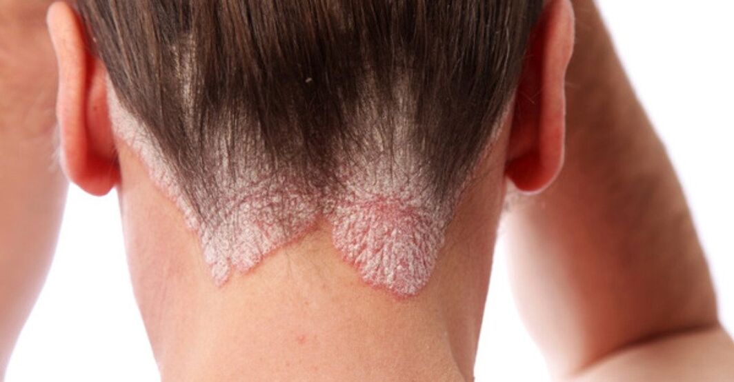 Psoriasis at the top of the girls