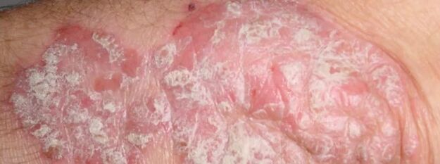Meznichered psoriasis