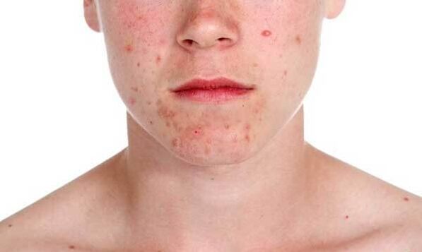 Symptoms of psoriasis