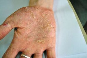 Psoriasis that you have