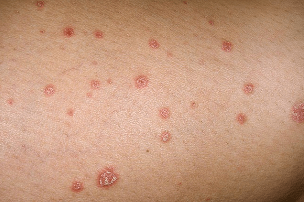 Psoriatic plaque