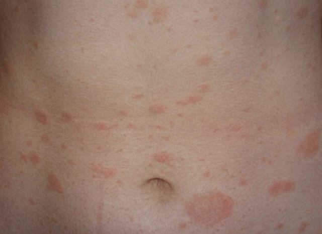 Regressive stage of psoriasis