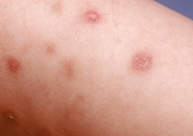 The initial stage of psoriasis