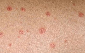 Psoriasis in the initial stage