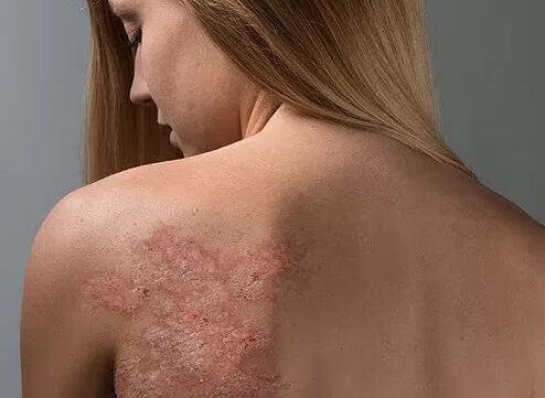 Psoriasis on the girl's back