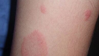 How does the initial stage of psoriasis manifest itself