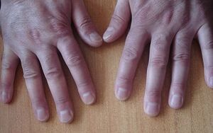 early signs of psoriasis