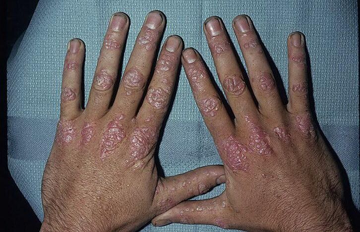 causes of the development of psoriasis on the hands