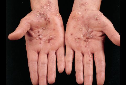How psoriasis looks on the palms of the hands