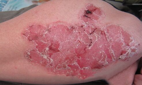 How pustular psoriasis looks on the skin