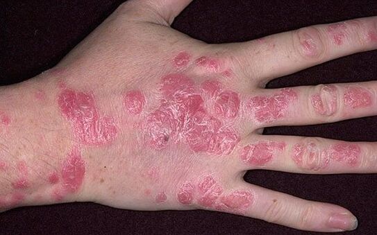 psoriasis on the hands plaque