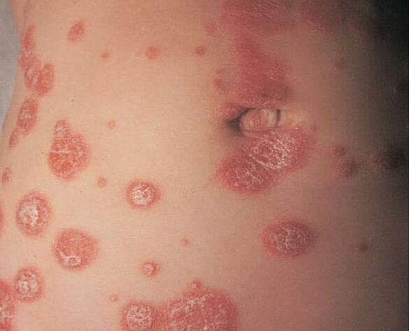 Red border around the papules