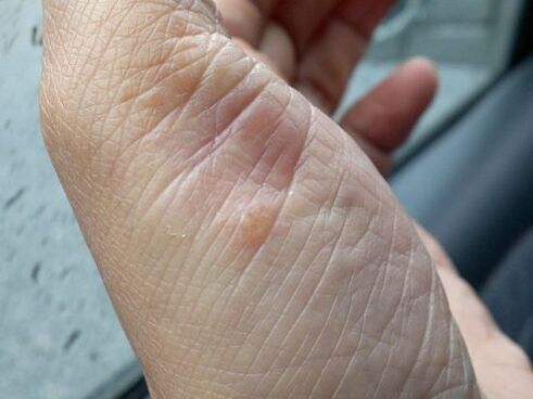 picture of psoriasis in hand