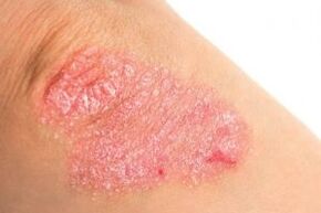 signs of psoriasis on the elbows