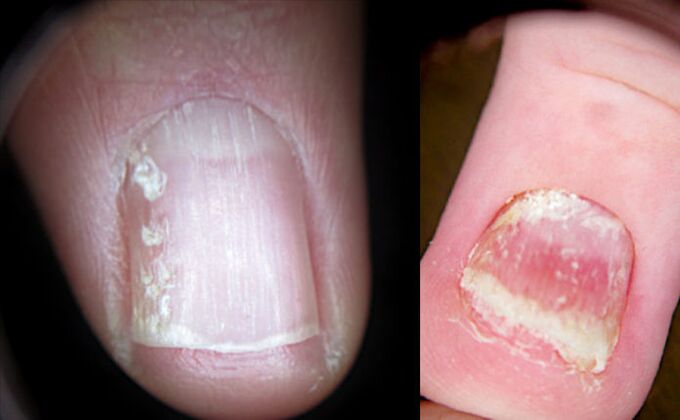 Crush the nails with psoriasis