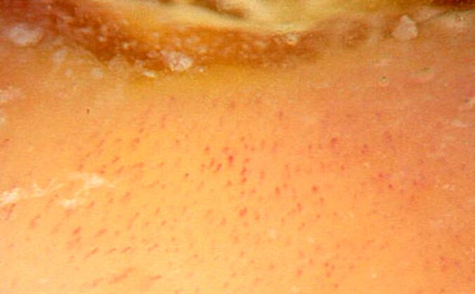Dermatoscopy with 40-fold magnification confirming psoriasis
