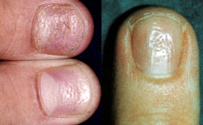 High symptom - multiple depressions on the surface of the nail plate
