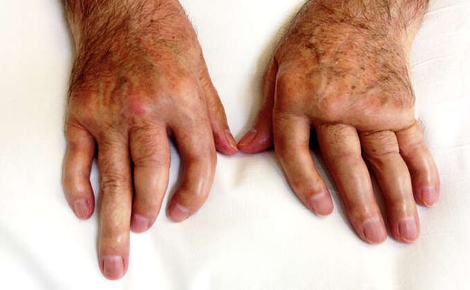 Injured arthritis in psoriasis