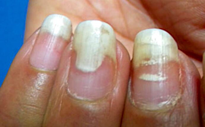 Onycholysis and leukonics after manicure