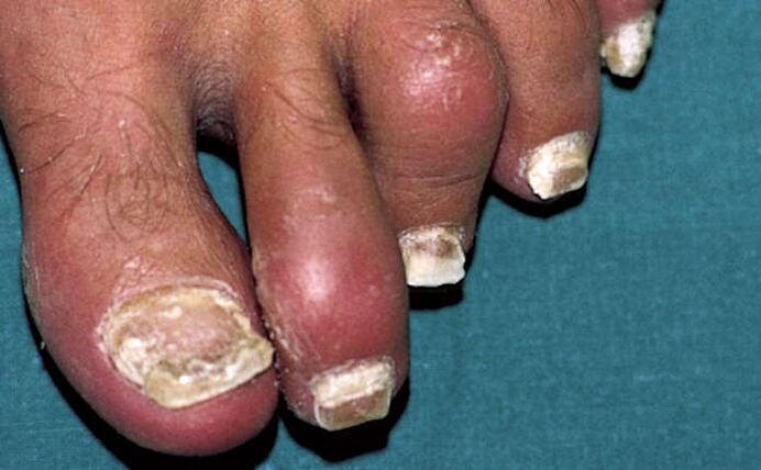 Psoriasis with nail eczema and arthritis of the fingers