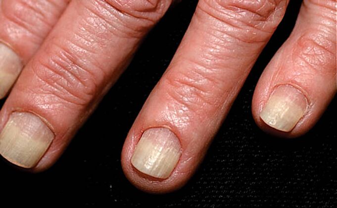 Spread of onycholysis from the edge of the nail to the nail layer