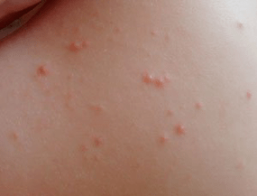 accurately identify the symptom of rash