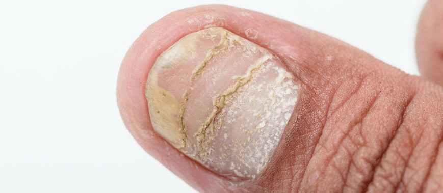 acute form of psoriasis of the nail