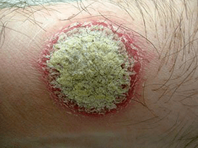 coin rash is a symptom of psoriasis